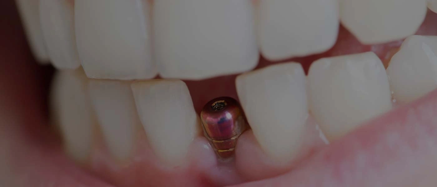 dental implants for one missing tooth