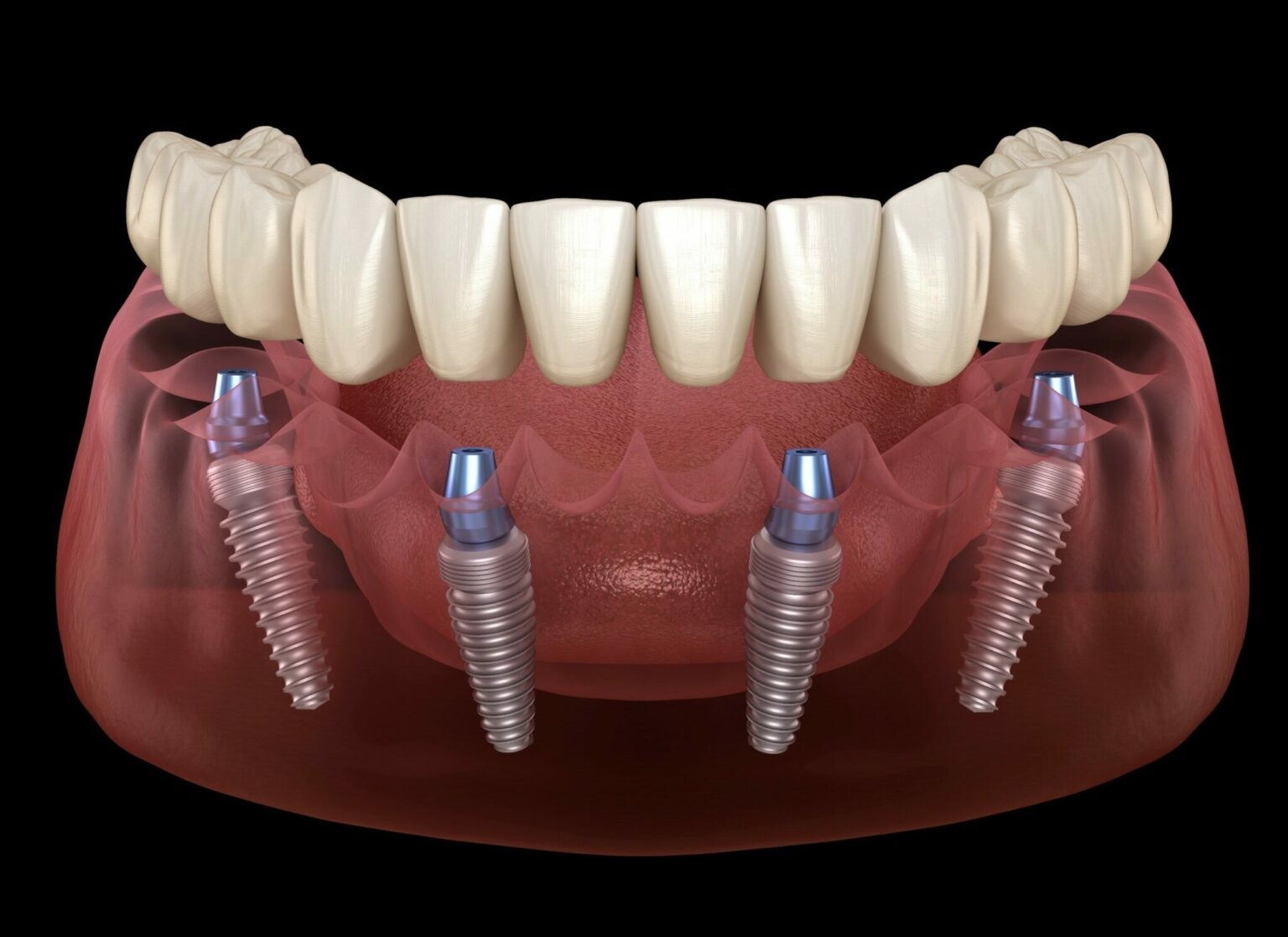 Implant Dentist Houston Tx